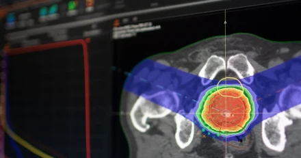 Hll koll p rekylen i Raysearch Kplge kan uppst High Quality